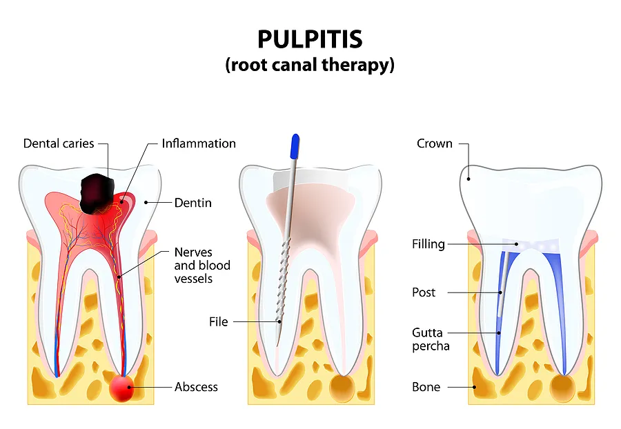 Everything You Need to Know About Root Canals in Woodlands, TX
